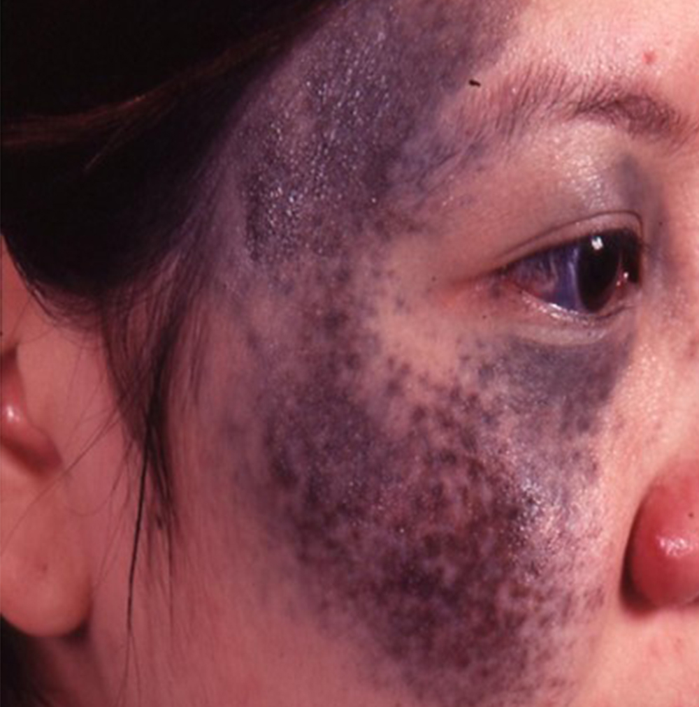 Birthmark Removal Dr Joycelim Dermatologist And Skin Specialist