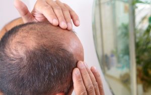 Hair Loss Treatment