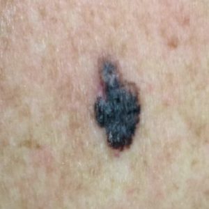 Mole Removal | Dr Joycelim Dermatologist & Skin Specialist