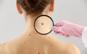 Skin Cancer Screening