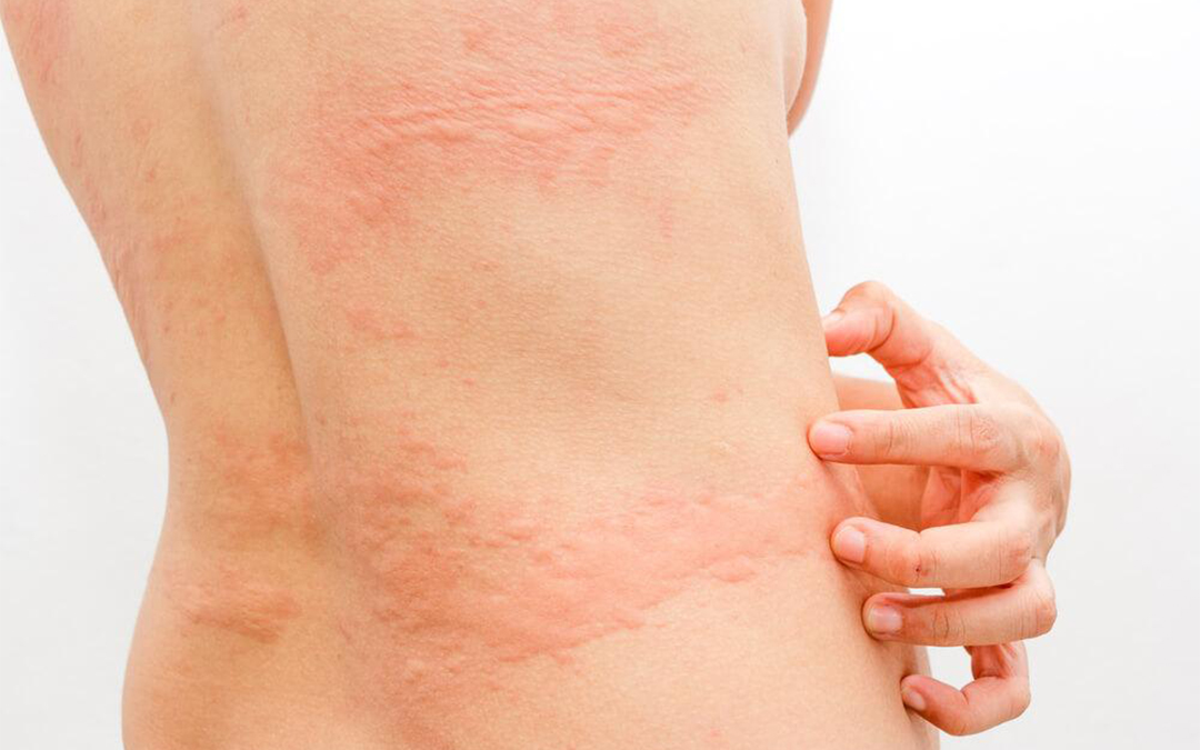 Urticaria Treatment - by Skin Specialist