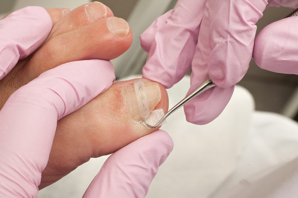 Can Pedicures Cause Ingrown Toenails