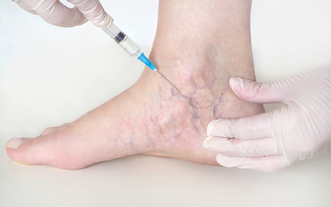 sclerotherapy for veins