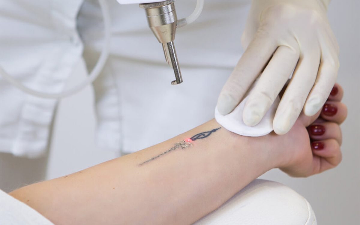 Want to Remove Your Tattoo? Know about Best Tattoo Removal in Bangalore