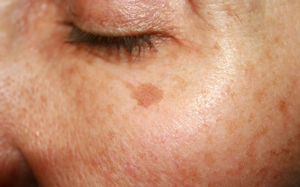 Pigmentation