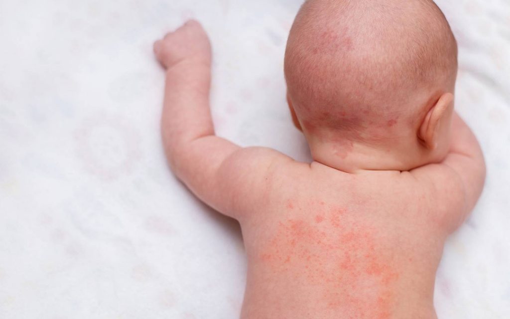 Baby Rash Treatment