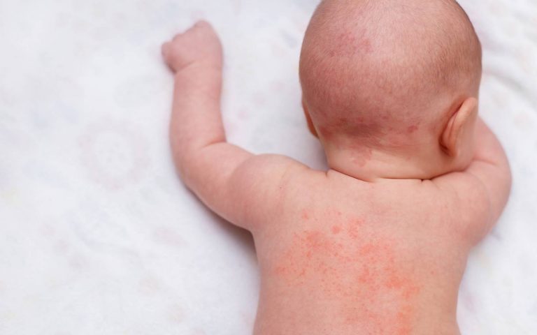 Baby Rash Treatment