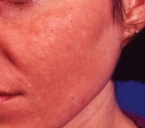 Melasma Pregnancy