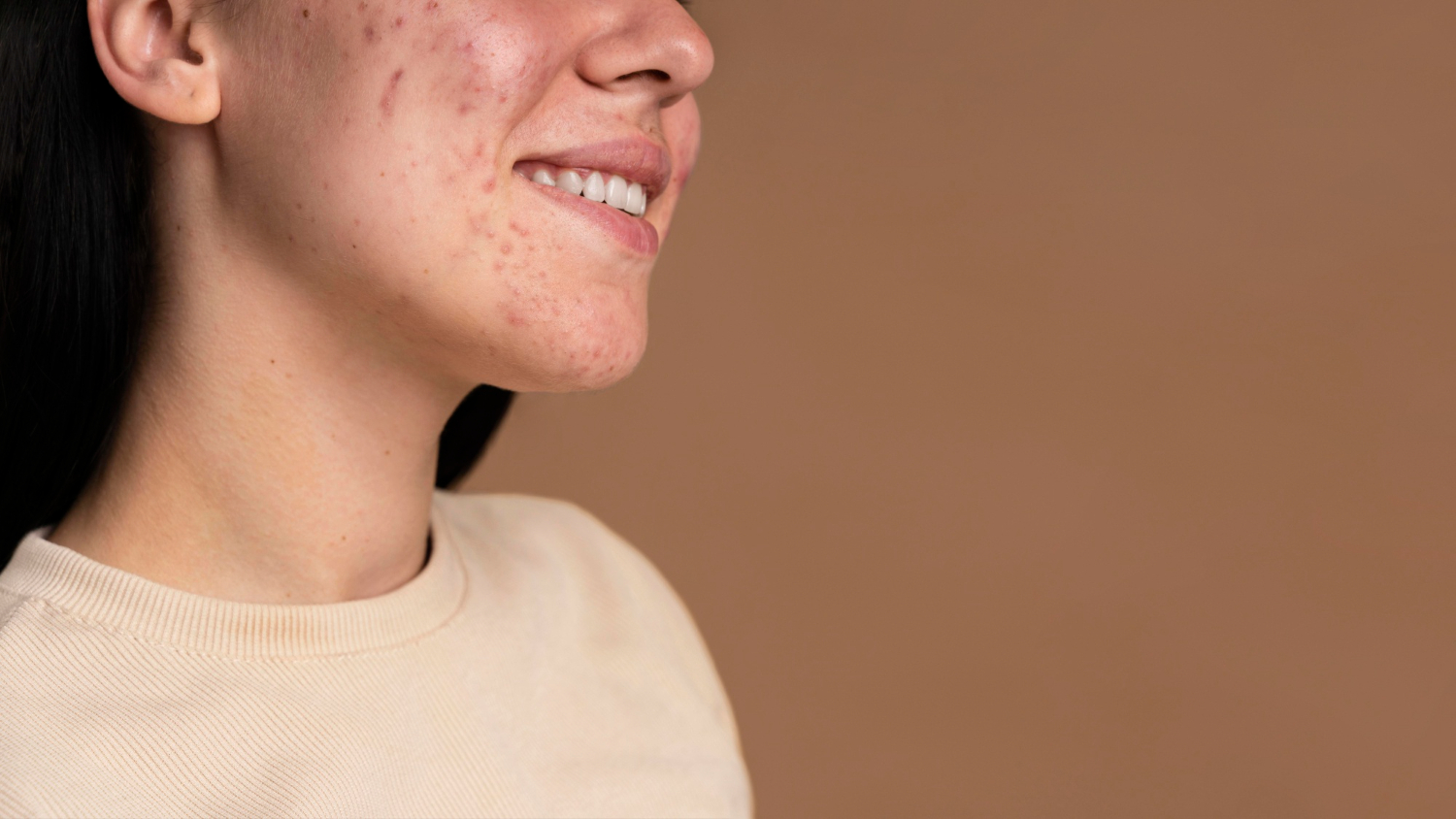 Close-up of the left side of a young person's face showing acne on the cheek, smiling, wearing a beige sweater against a tan background.
