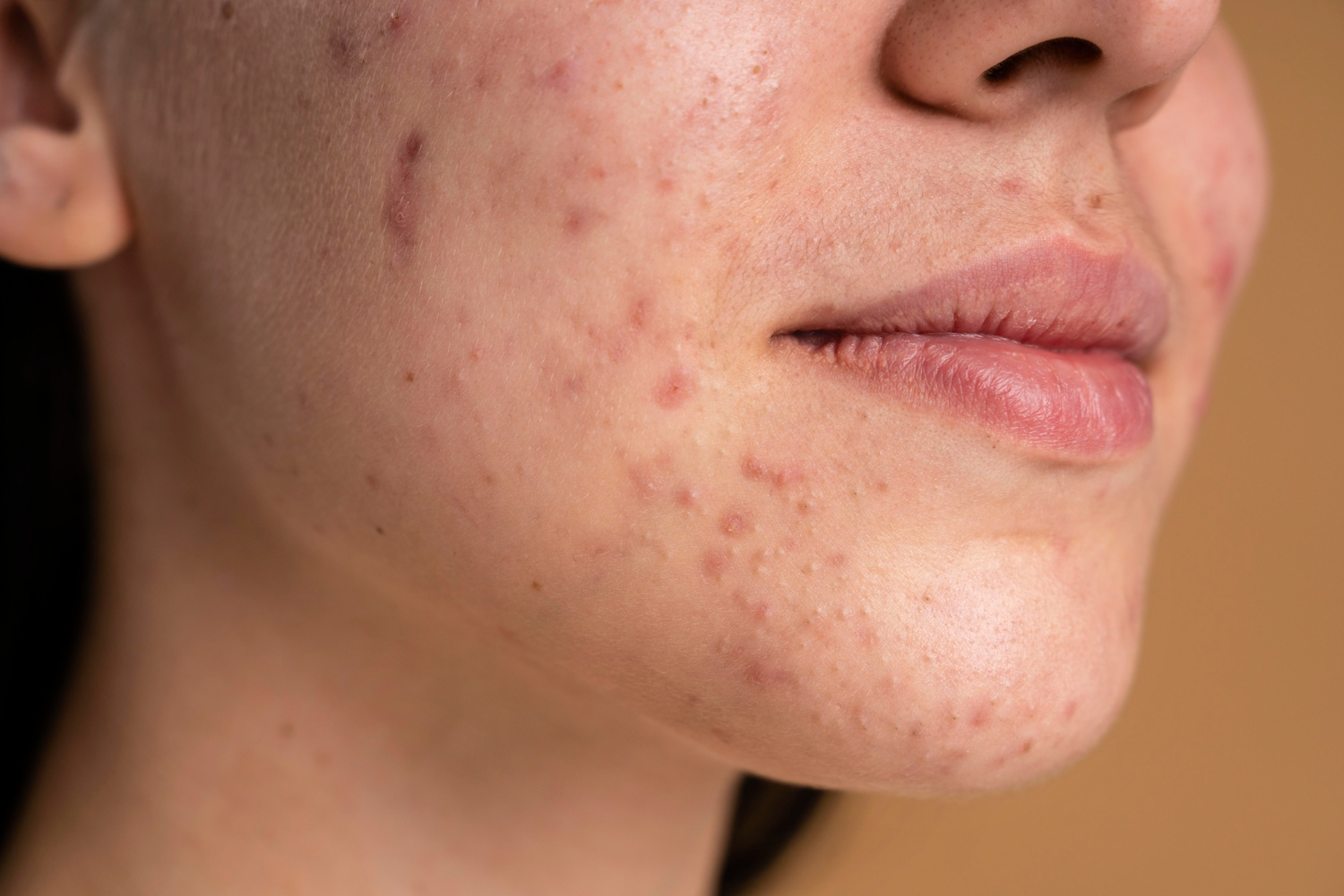 Close-up of a person's cheek and jaw with scattered red acne lesions and smooth lips in the foreground.