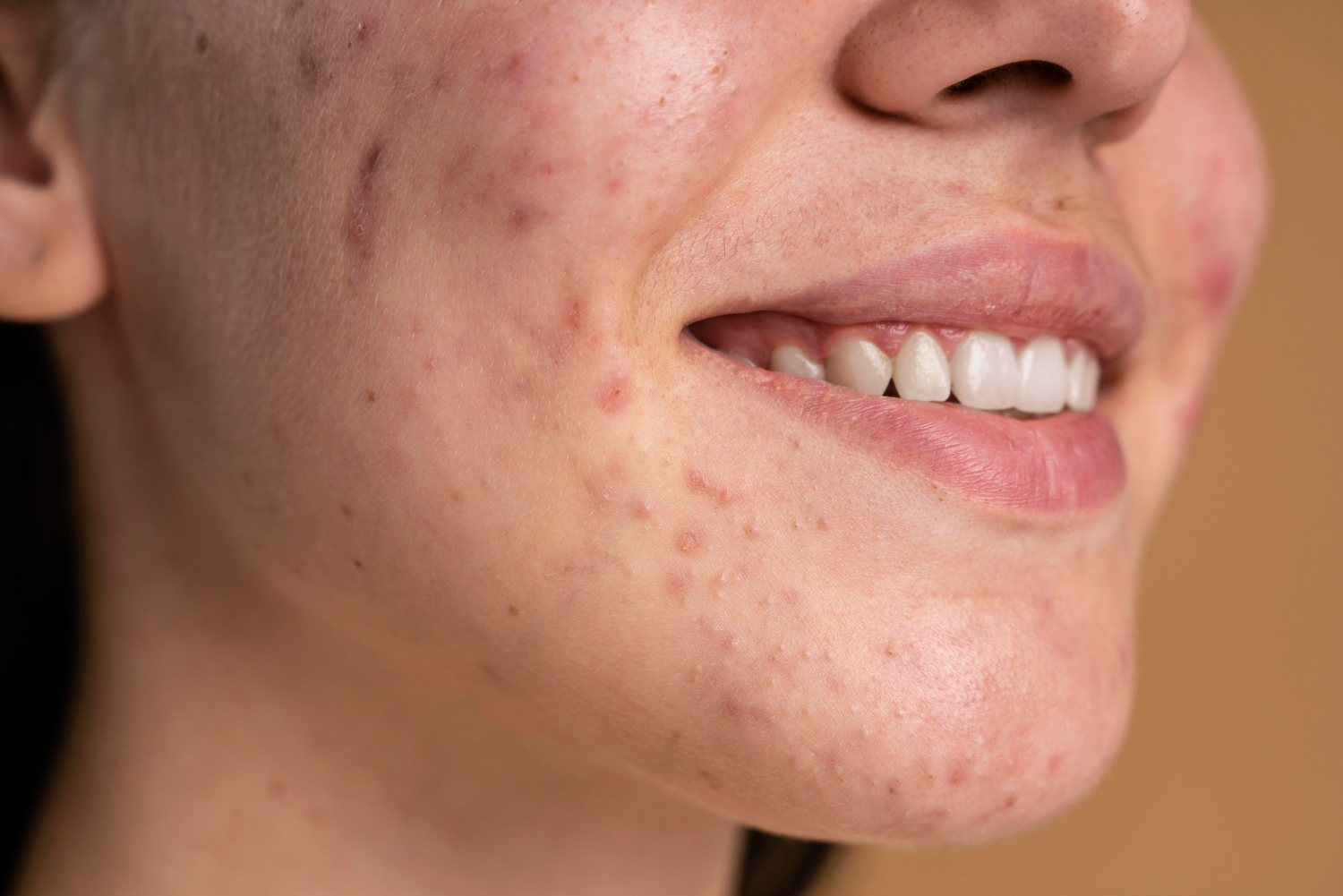 Close-up of a smiling person's cheek showing acne marks and clear teeth