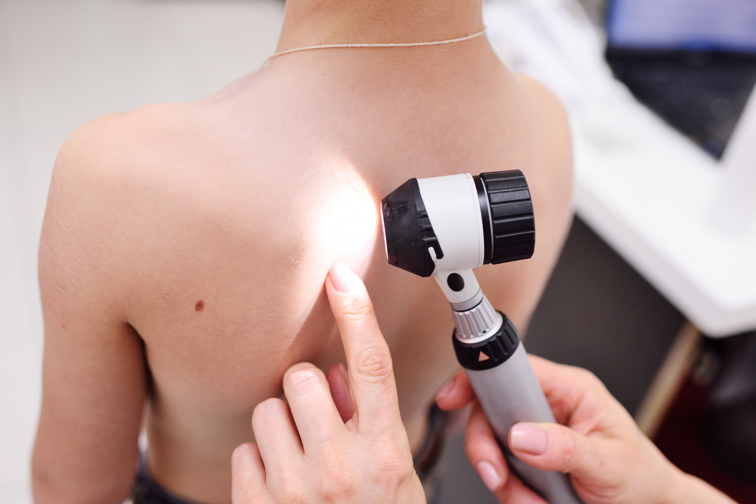 Dermatologist examines a mole on a patient’s back using a dermatoscope.