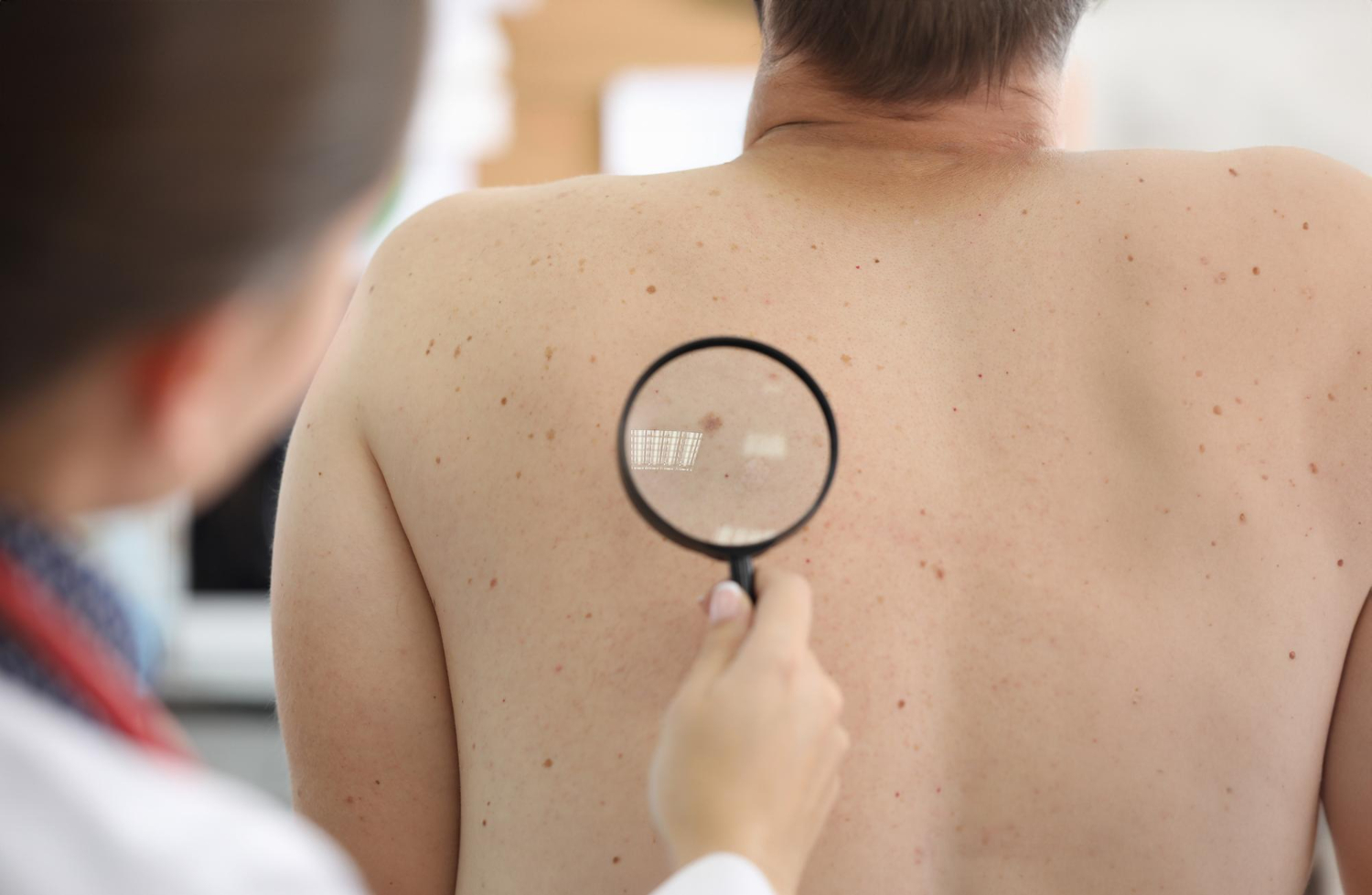 Medical skin check: clinician uses a magnifying glass to inspect a mole on a patient's back.
