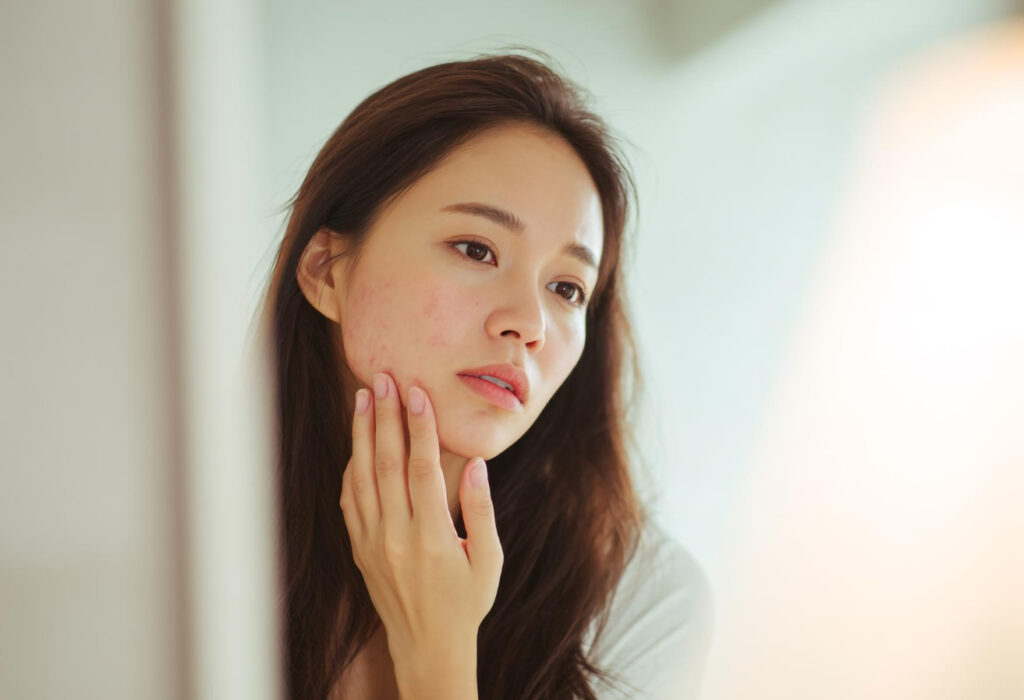 Young woman touches her cheek, showing mild acne on a light-skinned face against a soft, bright background.