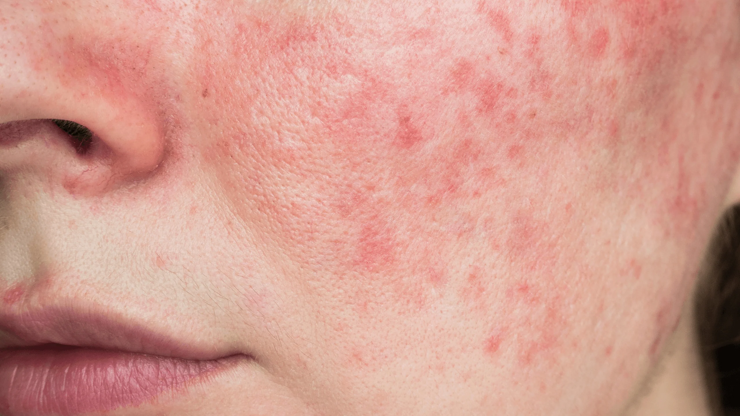 Close-up of a person's cheek showing red, inflamed patches and small pimples consistent with facial irritation or rosacea.