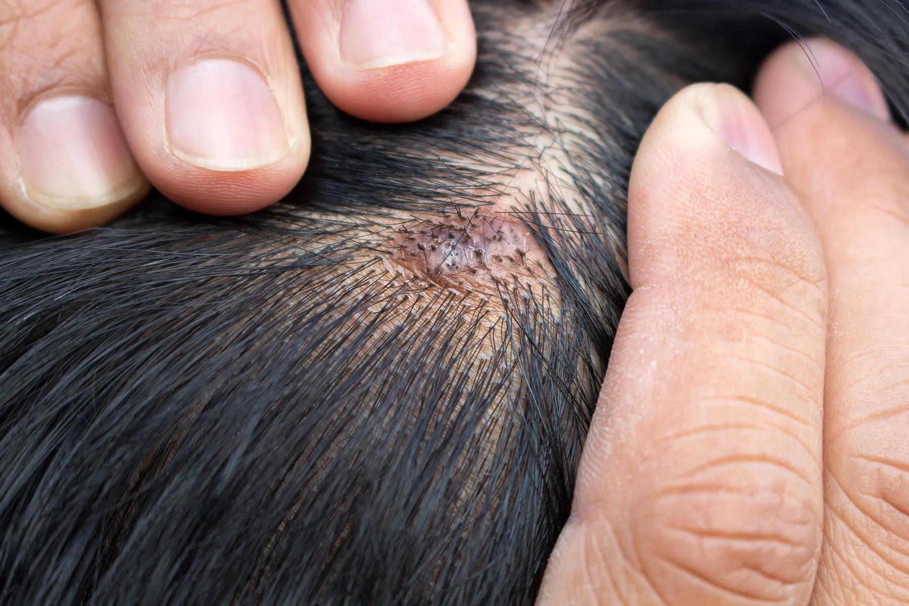 Close-up of a small brown crusted lesion on the scalp, revealed by parting the hair.