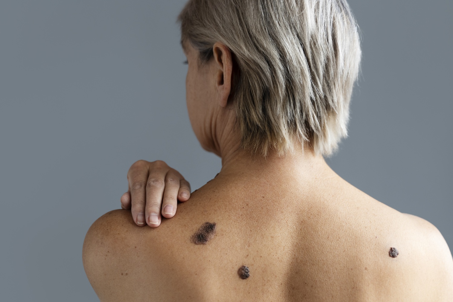 Read more about the article Does Treating Melanoma Always Mean Surgery, or Are There Other Treatment Options?